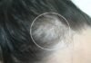 Reverse Female Hair Loss | Experience and tips