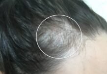 Reverse Female Hair Loss | Experience and tips