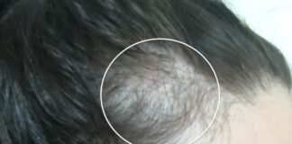Reverse Female Hair Loss | Experience and tips