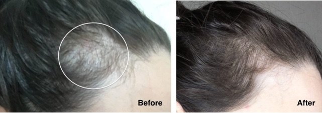 Reverse Female Hair Loss 