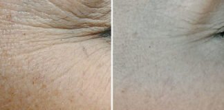 The Best 3 Homemade Wrinkle Cream Recipes for Smooth Skin