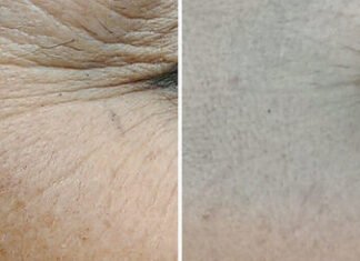 The Best 3 Homemade Wrinkle Cream Recipes for Smooth Skin