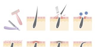 How to Prevent Ingrown Hairs ( Top Picks ) how-to-prevent-ingrown-hairs