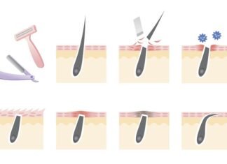 How to Prevent Ingrown Hairs ( Top Picks ) how-to-prevent-ingrown-hairs