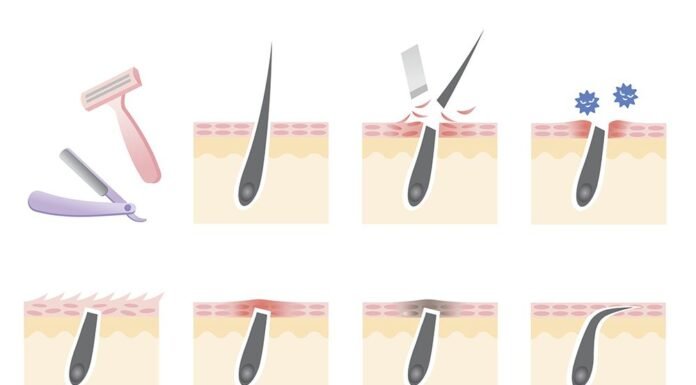 How to Prevent Ingrown Hairs ( Top Picks ) how-to-prevent-ingrown-hairs