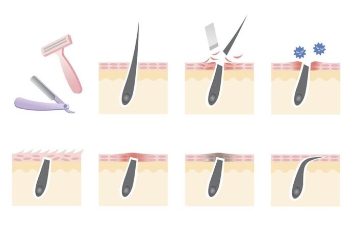 how-to-prevent-ingrown-hairs