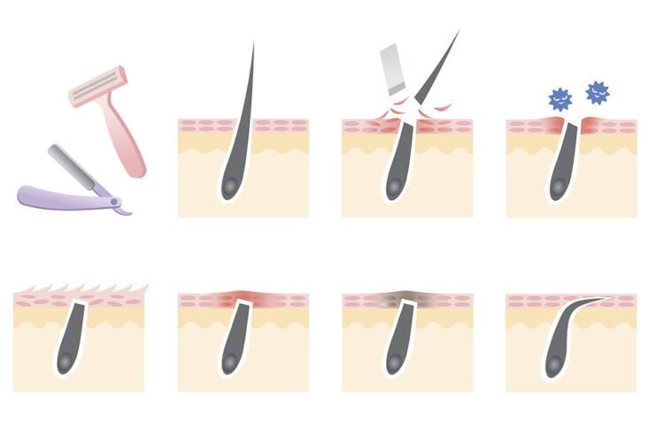 How to Prevent Ingrown Hairs ( Top Picks ) how-to-prevent-ingrown-hairs