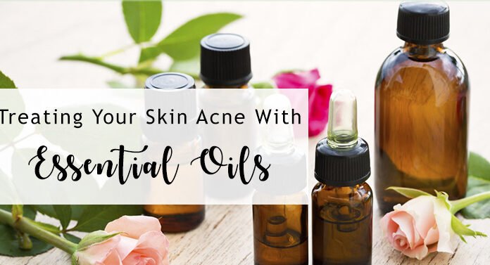 The 8 Best Essential Oils for Acne The 8 Best Essential Oils for Acne Review by Fix Your Skin